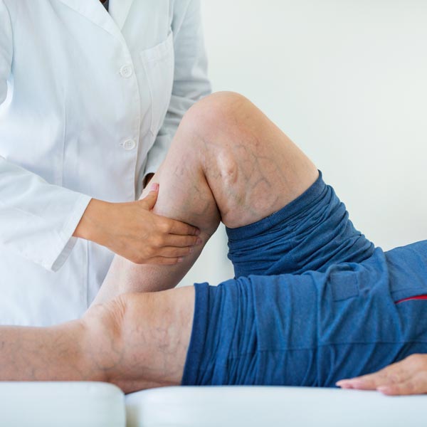 Doctor Examining Venous Leg in Los Altos, Los Gatos, Morgan Hill, & Salinas CA