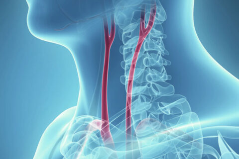 Treat Carotid Artery Disease at California Vein & Vascular Centers