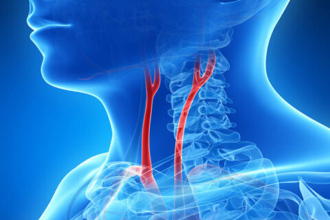 The animation of carotid artery