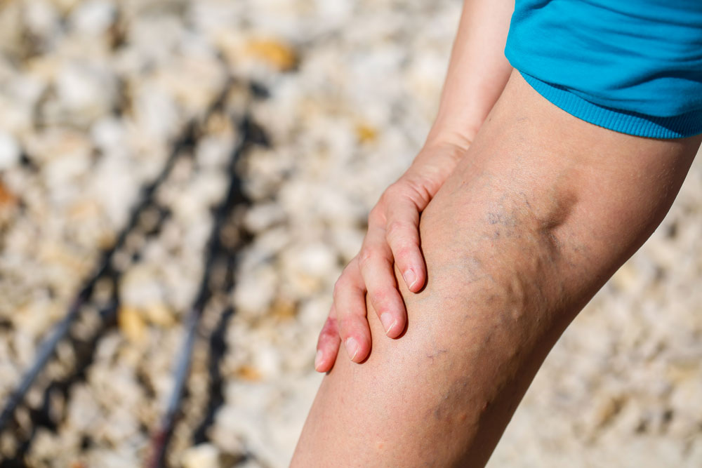 Cure for the person having Peripheral Artery Disease in the leg in Los Altos, CA