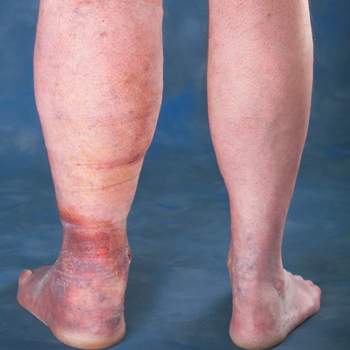 Edema Treatment in Los Altos, Los Gatos, Morgan Hill, & Salinas CA