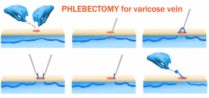 Ambulatory Phlebectomy Procedure in Los Altos, Los Gatos, Morgan Hill, and Salinas, CA