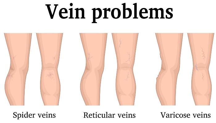 Different Types of Vein Problems & Treatment in Los Altos, Los Gatos, Morgan Hill, and Salinas, CA