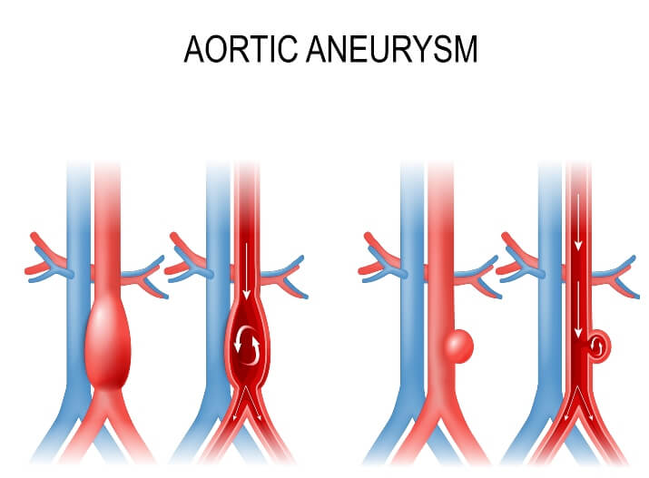 Different types of Aneurysms