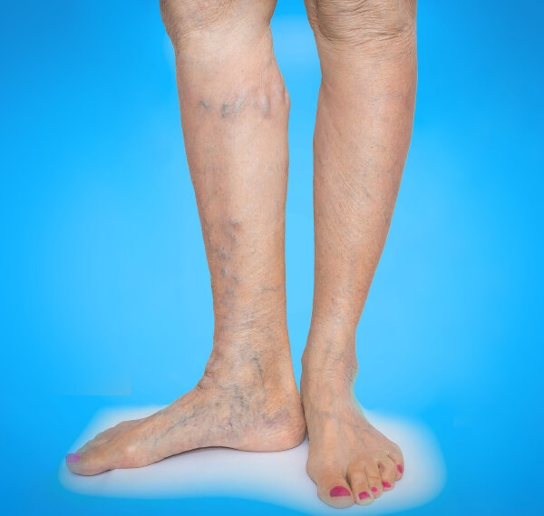 Treatment for Legs with Varicose Veins in Los Altos, Los Gatos, Morgan Hill, and Salinas, CA