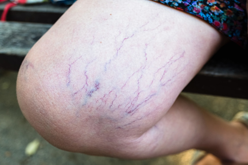 5 Key Factors That Increase Your Risk of Spider Veins