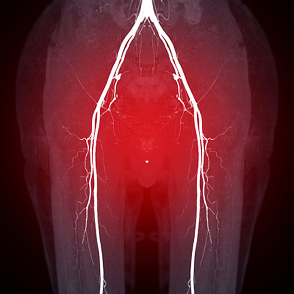 Aortoiliac Occlusive Disease
