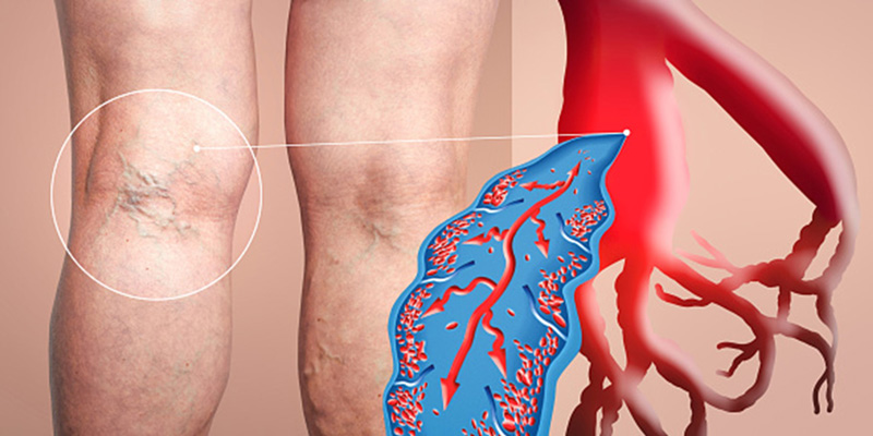 Deep-Venous-Thrombosis