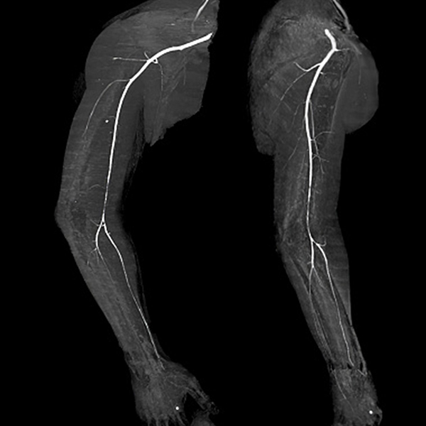 Upper-Extremity-Disorders