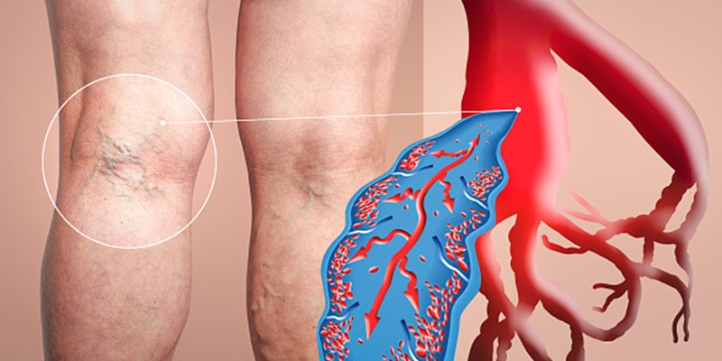 Deep venous thrombosis care and treatment in California