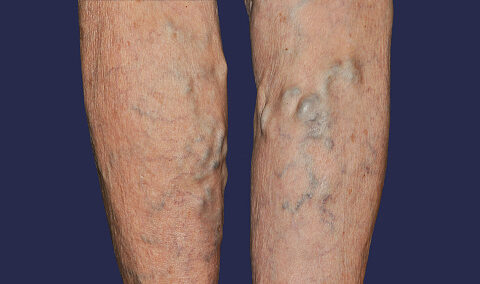 Deep vein thrombosis treatment in the Greater San Jose and Monterey County areas.
