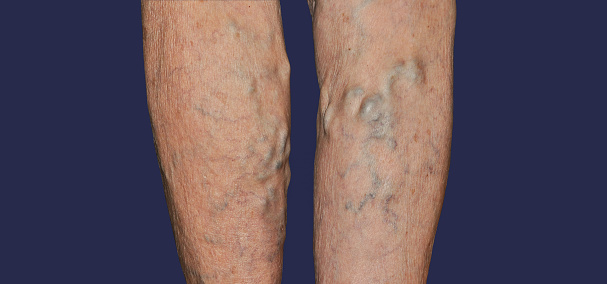 Deep vein thrombosis treatment in the Greater San Jose and Monterey County areas.