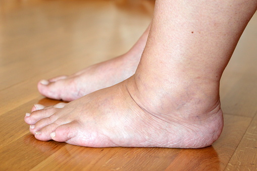 Foot swelling treatment in the Greater San Jose and Monterey County areas.