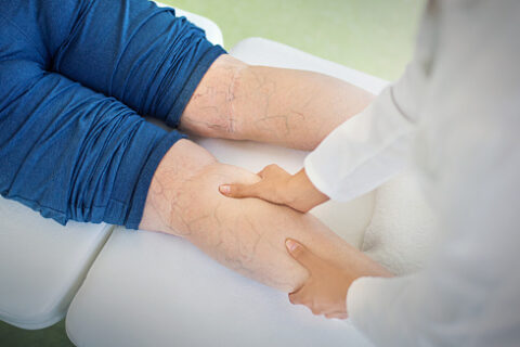 Varicose veins removal in Greater San Jose and Monterey County areas.