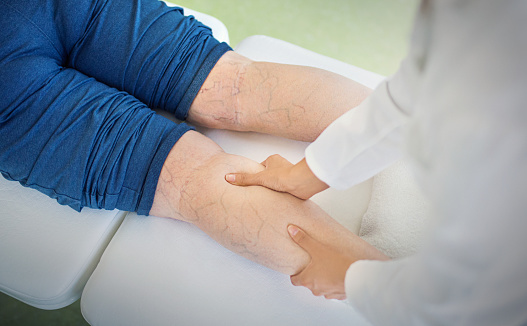 Varicose veins removal in Greater San Jose and Monterey County areas.