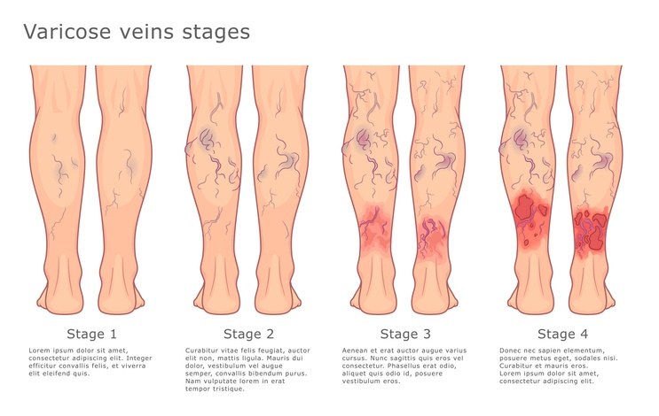 Varicose Veins Stages Explained in the Bay Area, CA